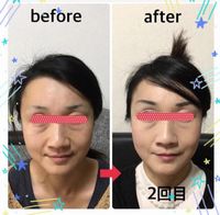 小顔矯正結果
