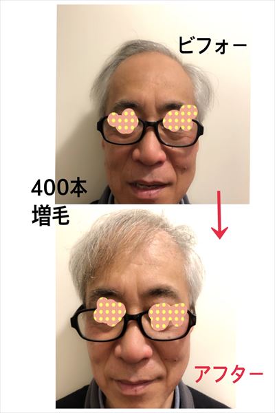 加齢による毛髪トラブル増毛例1(拡大画像)