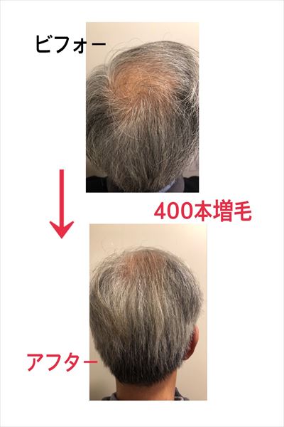 加齢による毛髪トラブル増毛例2(拡大画像)